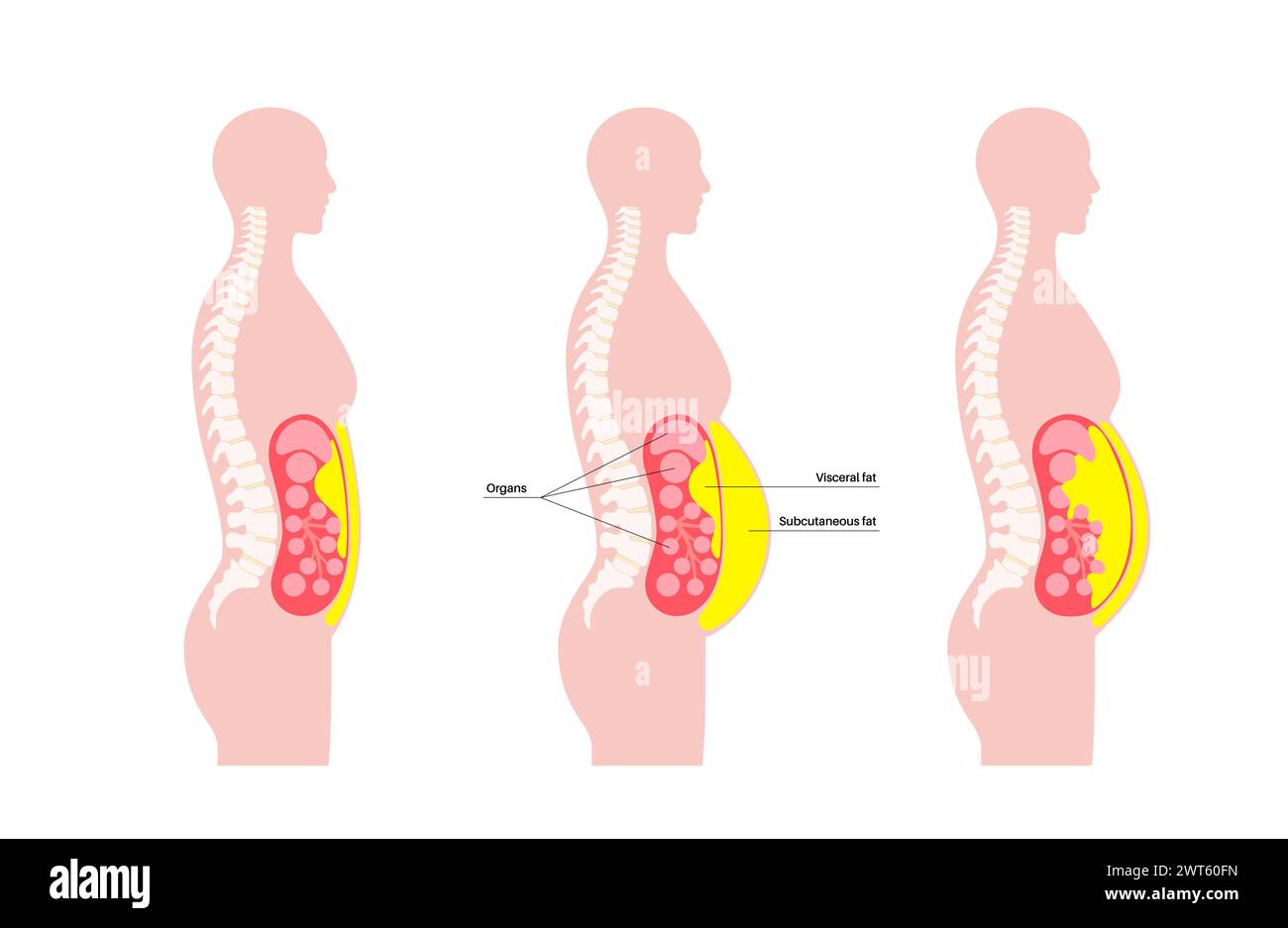 Schéma de la graisse viscérale, illustration. La graisse du ventre entoure les organes internes dans la cavité abdominale. Banque D'Images