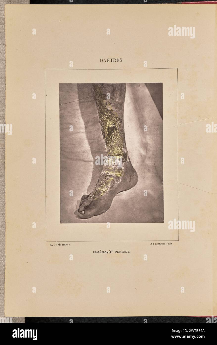 Eczéma, 2e période. Arthur de Montmeja, photographe (français, né en 1841) négatif vers 1867, impression 1882 vue rapprochée d'une jambe et d'un pied recouverts de plaies, d'écailles et de flocons de dermatite atopique subaiguë, également connu sous le nom d'eczéma. (Recto, monture) haut centre, imprimé à l'encre noire : 'DARTRES' en bas à gauche, imprimé à l'encre noire : 'A. de Montmeja' en bas centre, imprimé à l'encre noire : 'ECZÉMA 2e PÉRIODE' en bas à droite, imprimé à l'encre noire : 'ad naturam fecit' Banque D'Images