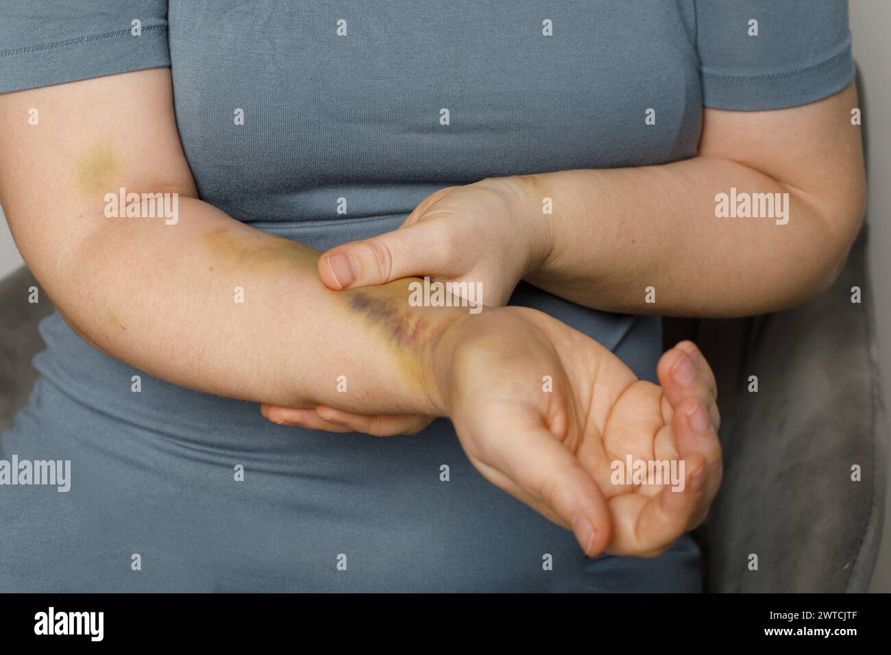 Main humaine avec ecchymose d'accident de voiture Banque D'Images