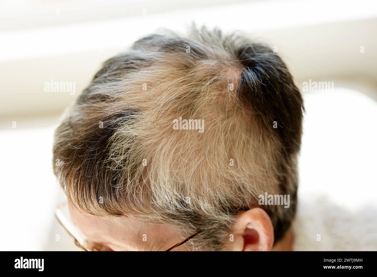 Femme avec alopécie Banque D'Images