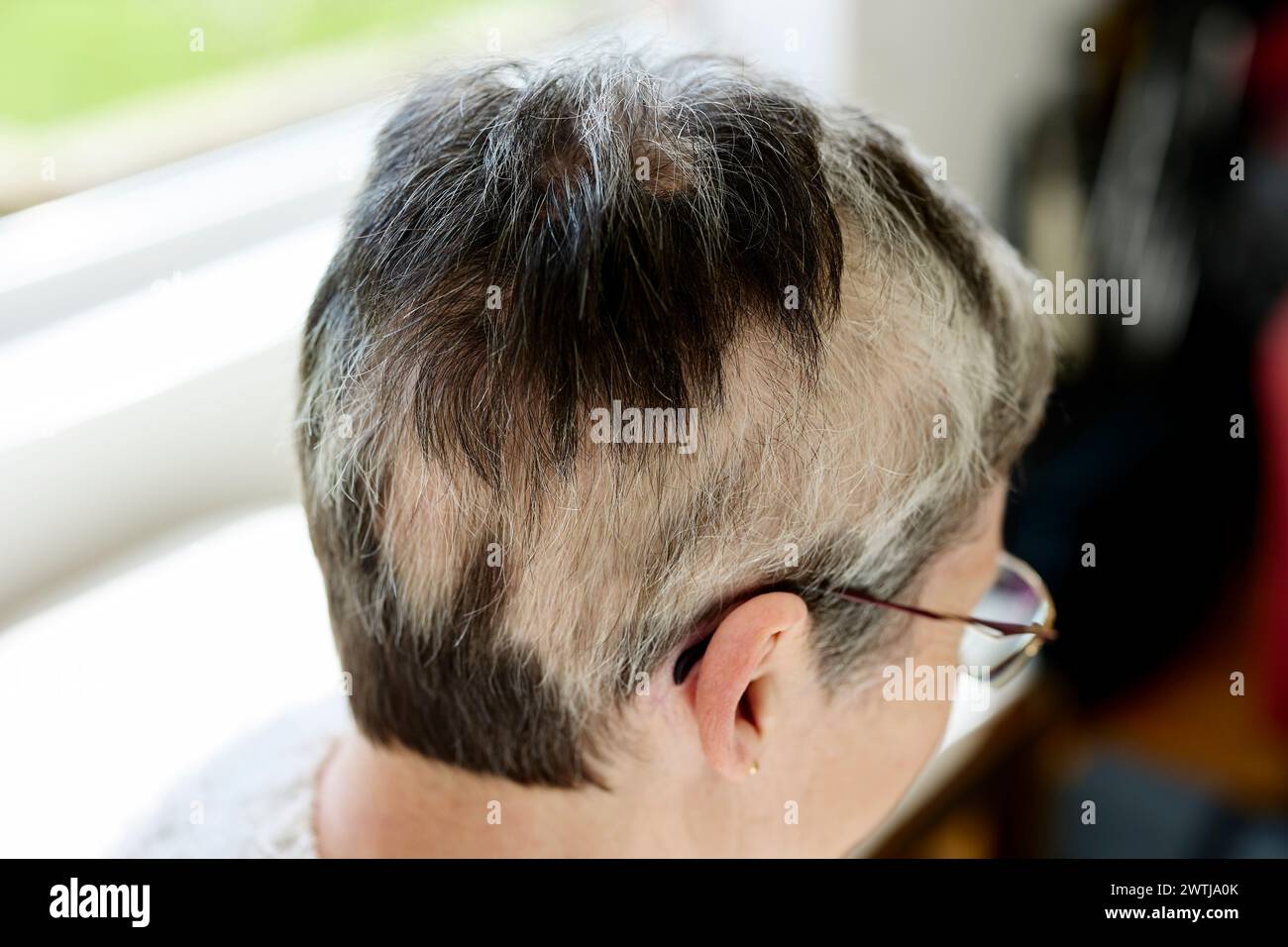 Femme avec alopécie Banque D'Images