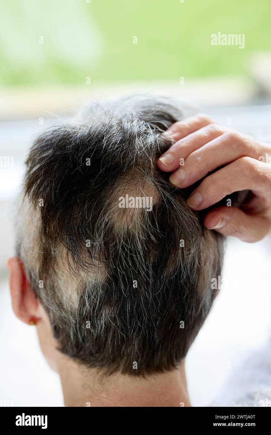 Femme avec alopécie Banque D'Images