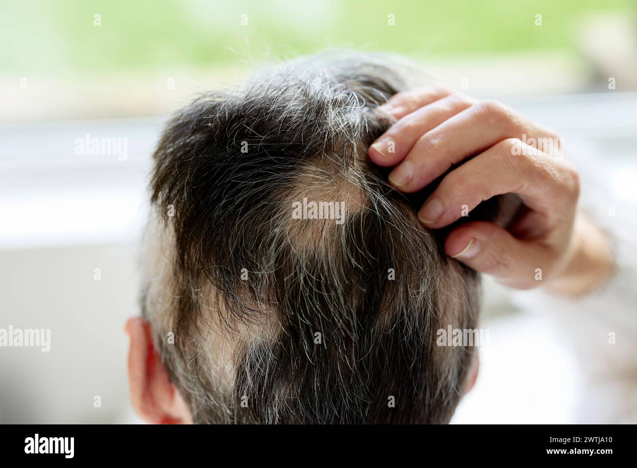 Femme avec alopécie Banque D'Images