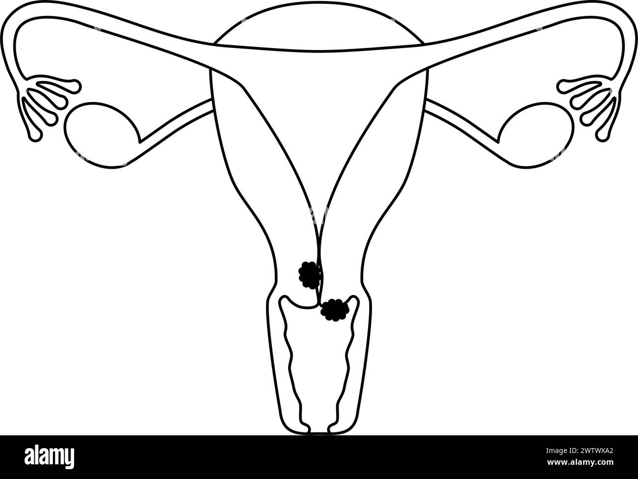 Illustration schématique du cancer du col de l'utérus, anatomie de l'utérus et des ovaires, illustration vectorielle Illustration de Vecteur
