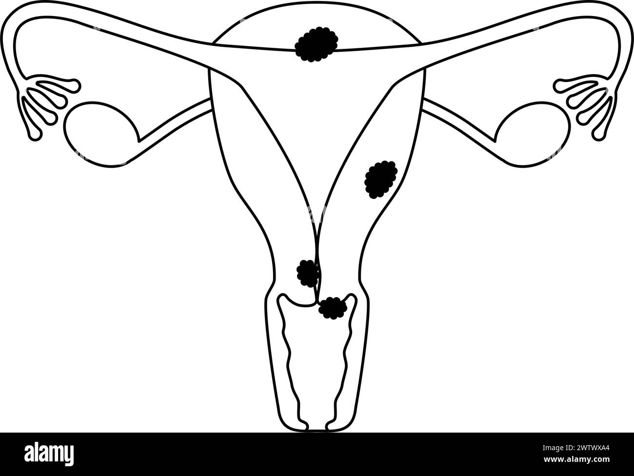 Illustration schématique du cancer du col de l'utérus, anatomie de l'utérus et des ovaires, illustration vectorielle Illustration de Vecteur
