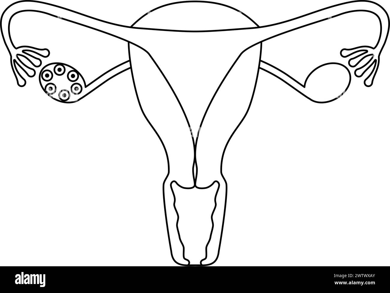 Illustration schématique du syndrome des ovaires polykystiques (trouble de l