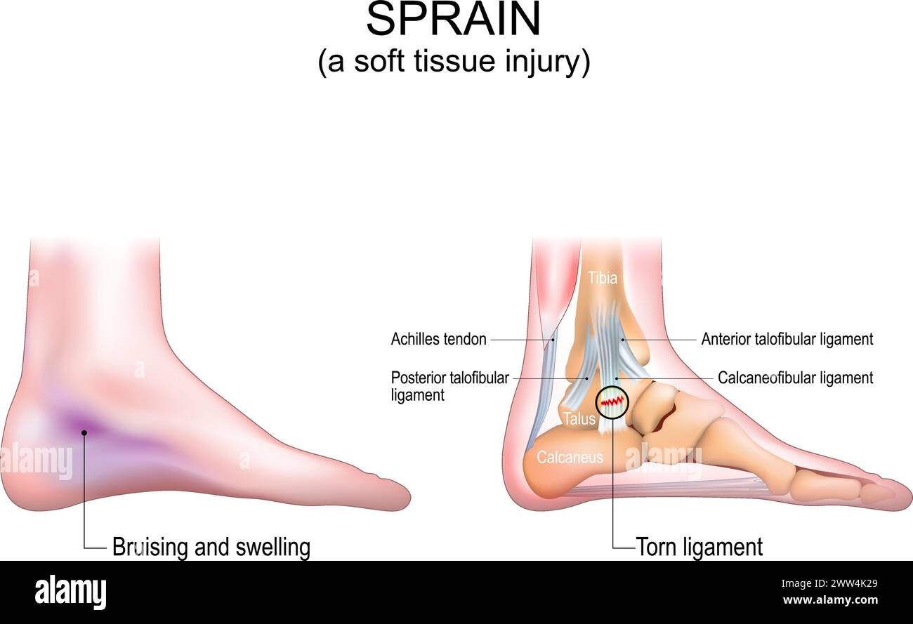 Entorse. Une lésion des tissus mous du pied humain. Ecchymoses et gonflement de la peau de la jambe. Gros plan d'un tendon d'Achille, des os du pied et des ligaments. Déchiré o Illustration de Vecteur Entorse. Une lésion des tissus mous du pied humain. Ecchymoses et gonflement de la peau de la jambe. Gros plan d'un tendon d'Achille, des os du pied et des ligaments. Déchiré o Illustration de Vecteur