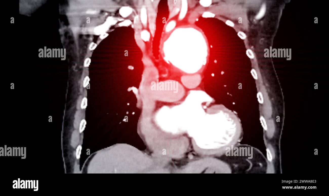 L'imagerie par angiographie par TDM de l'aorte entière la vue frontale affichant un anévrisme aortique fournit une évaluation complète pour un diagnostic précis et une planification du traitement. Banque D'Images