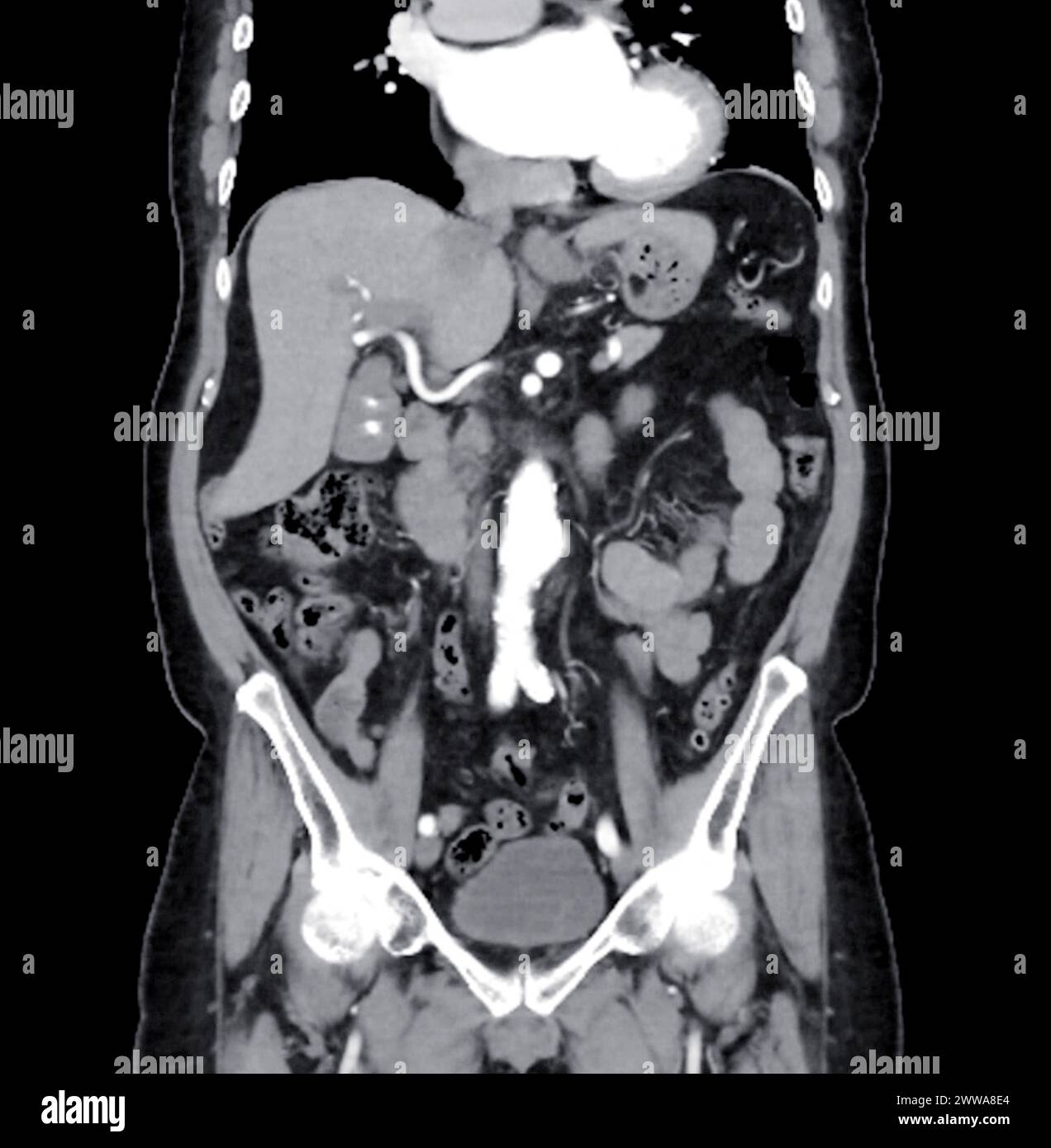 Tomodensitométrie de l'abdomen entier avec injection de produit de contraste en vue frontale. Banque D'Images