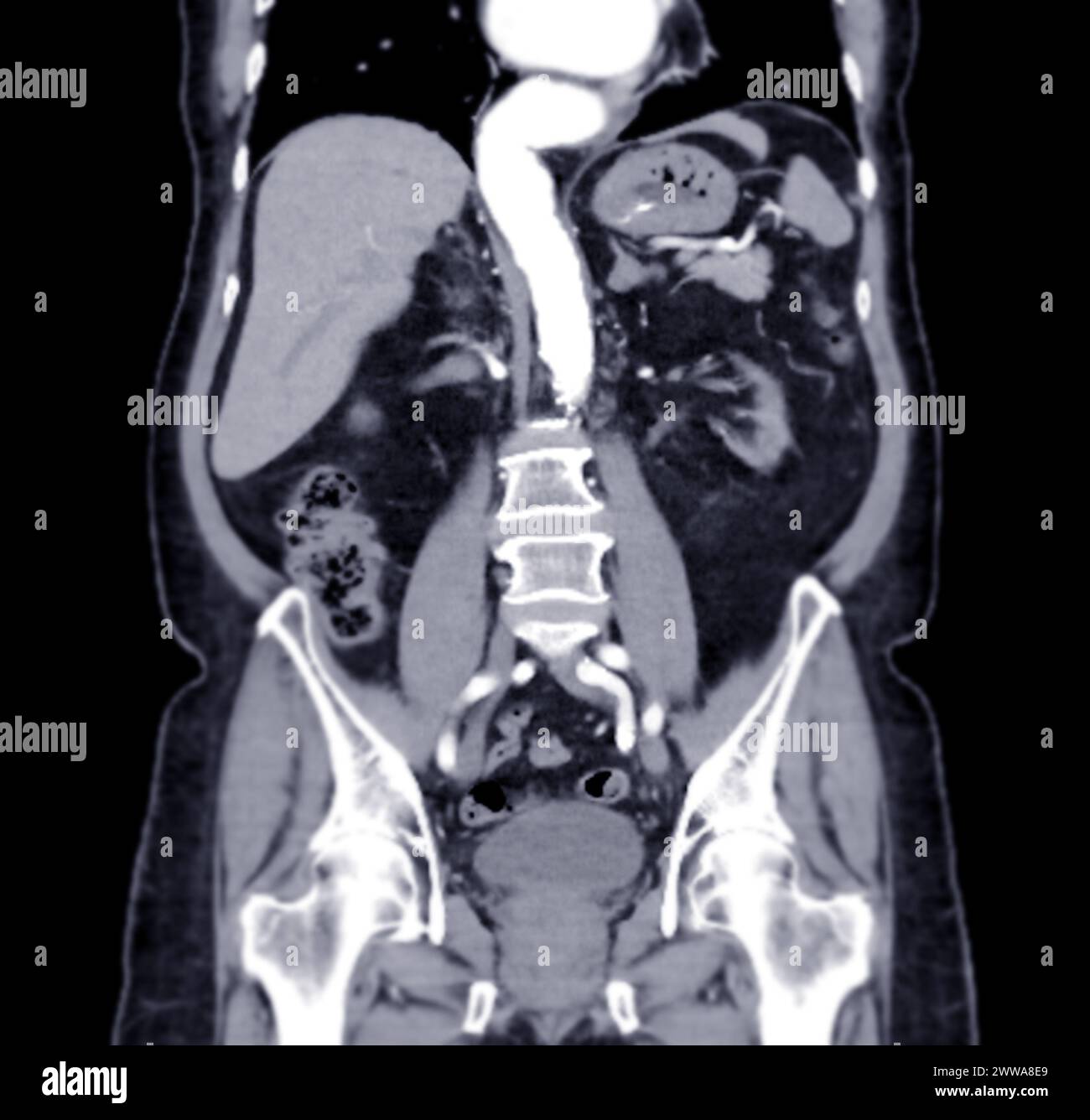 Tomodensitométrie de l'abdomen entier avec injection de produit de contraste en vue frontale. Banque D'Images