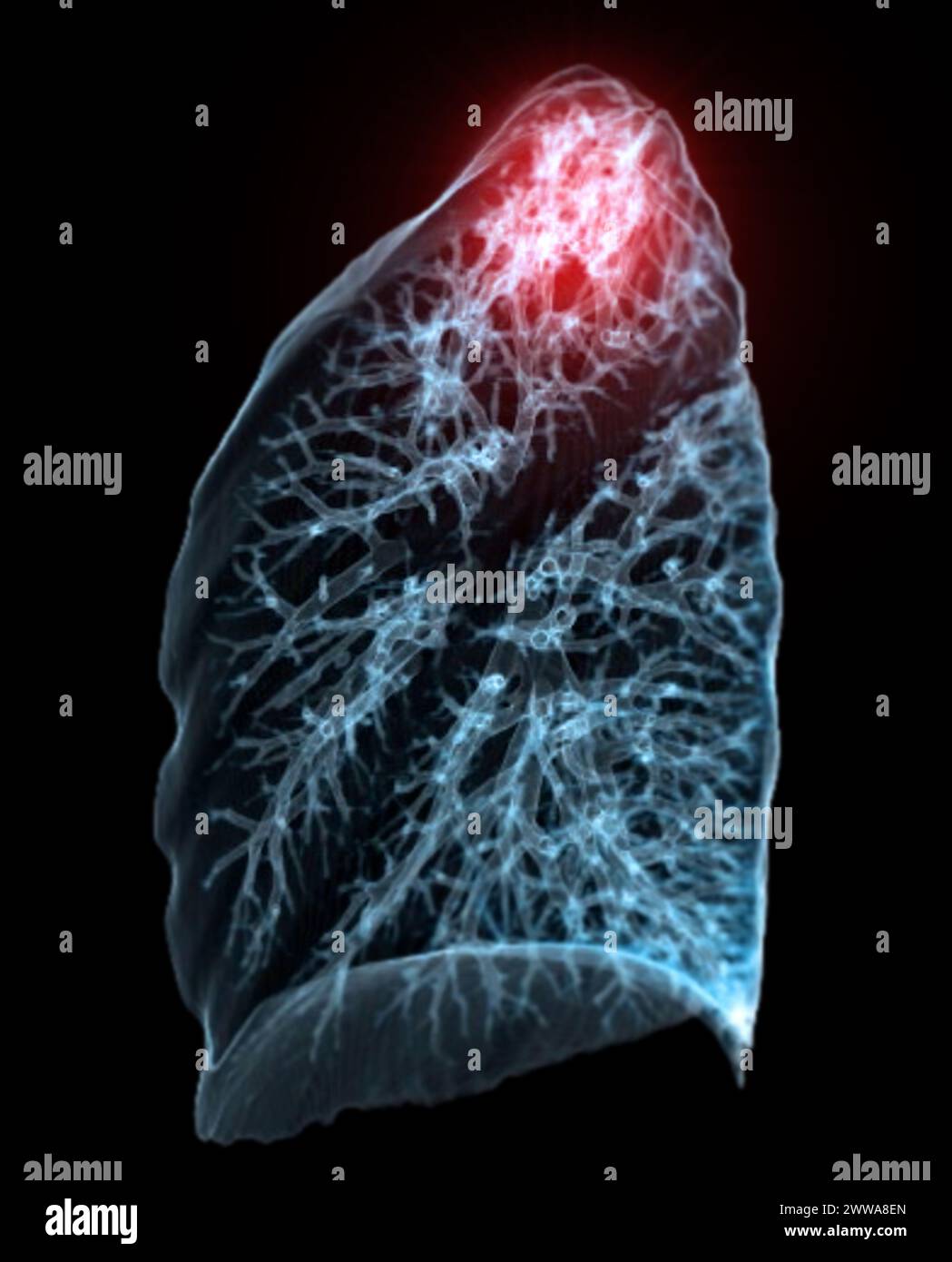 Une tomodensitométrie thoracique 3D affichant une lésion au niveau du lobe supérieur droit offre une visualisation détaillée, facilitant ainsi l'identification précise et le traitement Banque D'Images