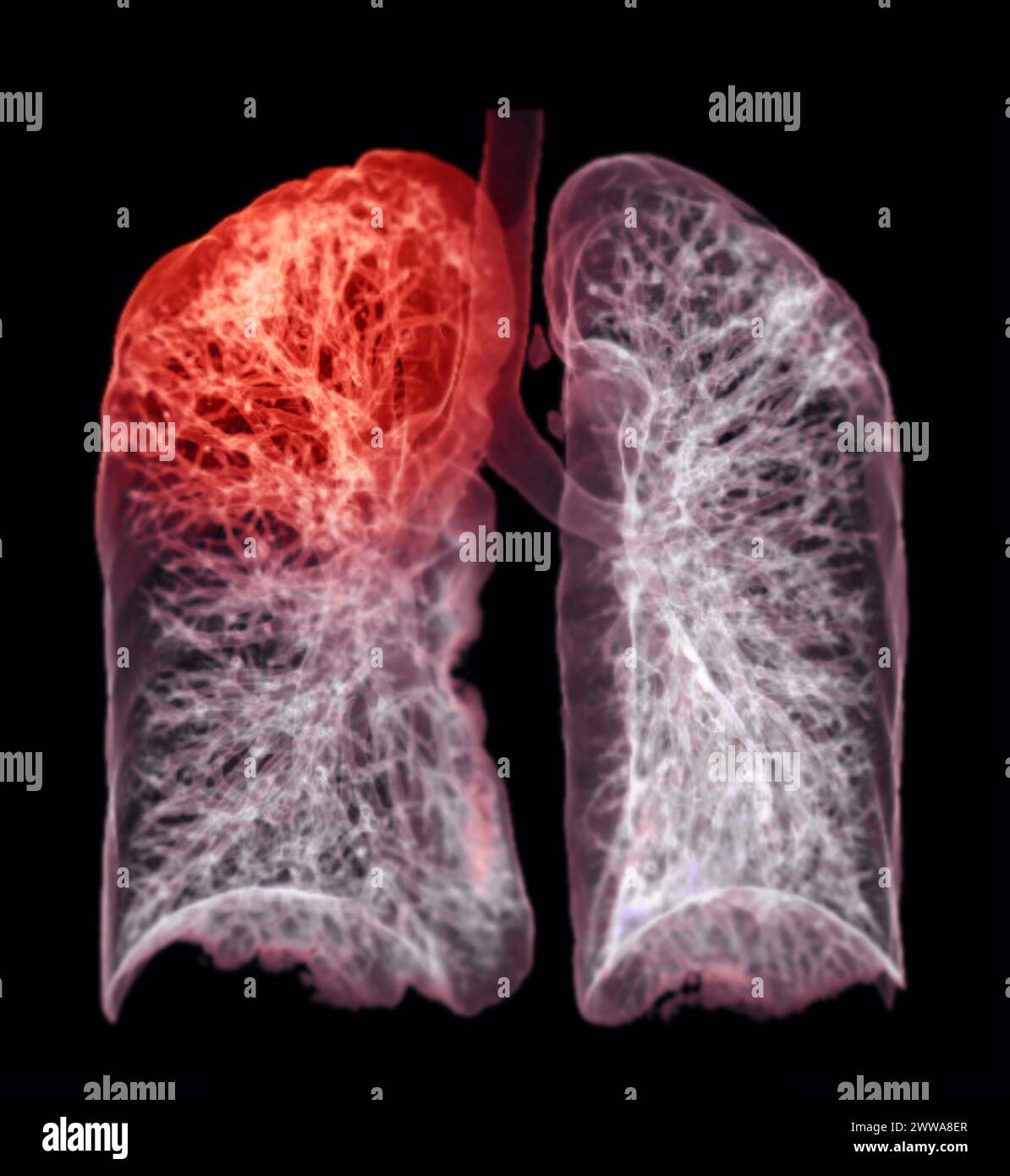 Une tomodensitométrie thoracique 3D affichant une lésion au niveau du lobe supérieur droit offre une visualisation détaillée, facilitant ainsi l'identification précise et le traitement Banque D'Images