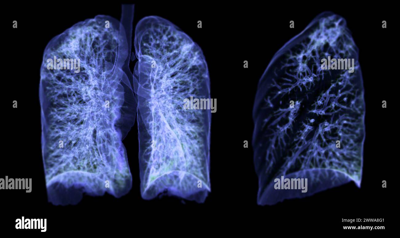 Une tomodensitométrie thoracique 3D affichant une lésion au niveau du lobe supérieur droit offre une visualisation détaillée, facilitant ainsi l'identification précise et le traitement Banque D'Images