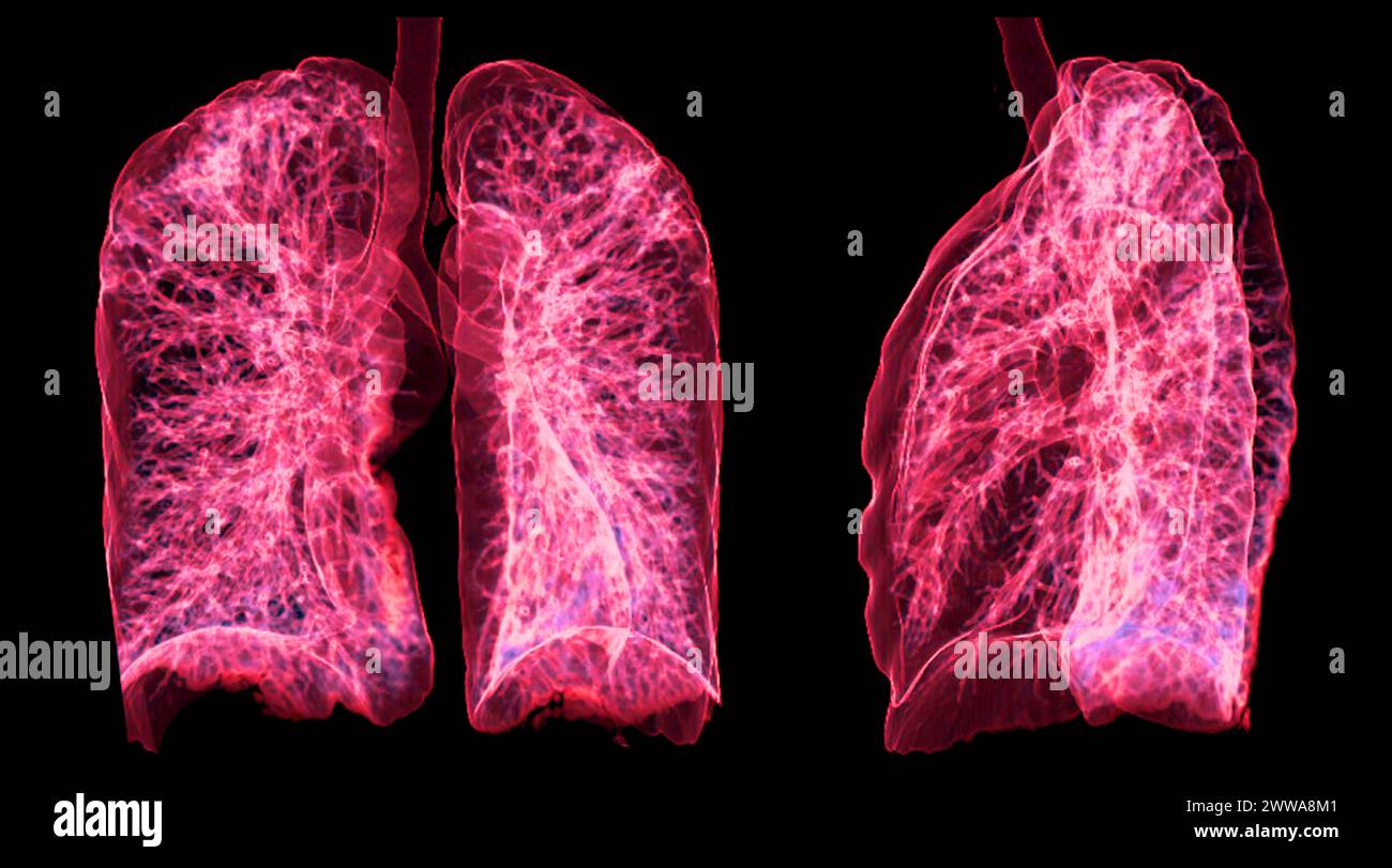 Une tomodensitométrie thoracique 3D affichant une lésion au niveau du lobe supérieur droit offre une visualisation détaillée, facilitant ainsi l'identification précise et le traitement Banque D'Images