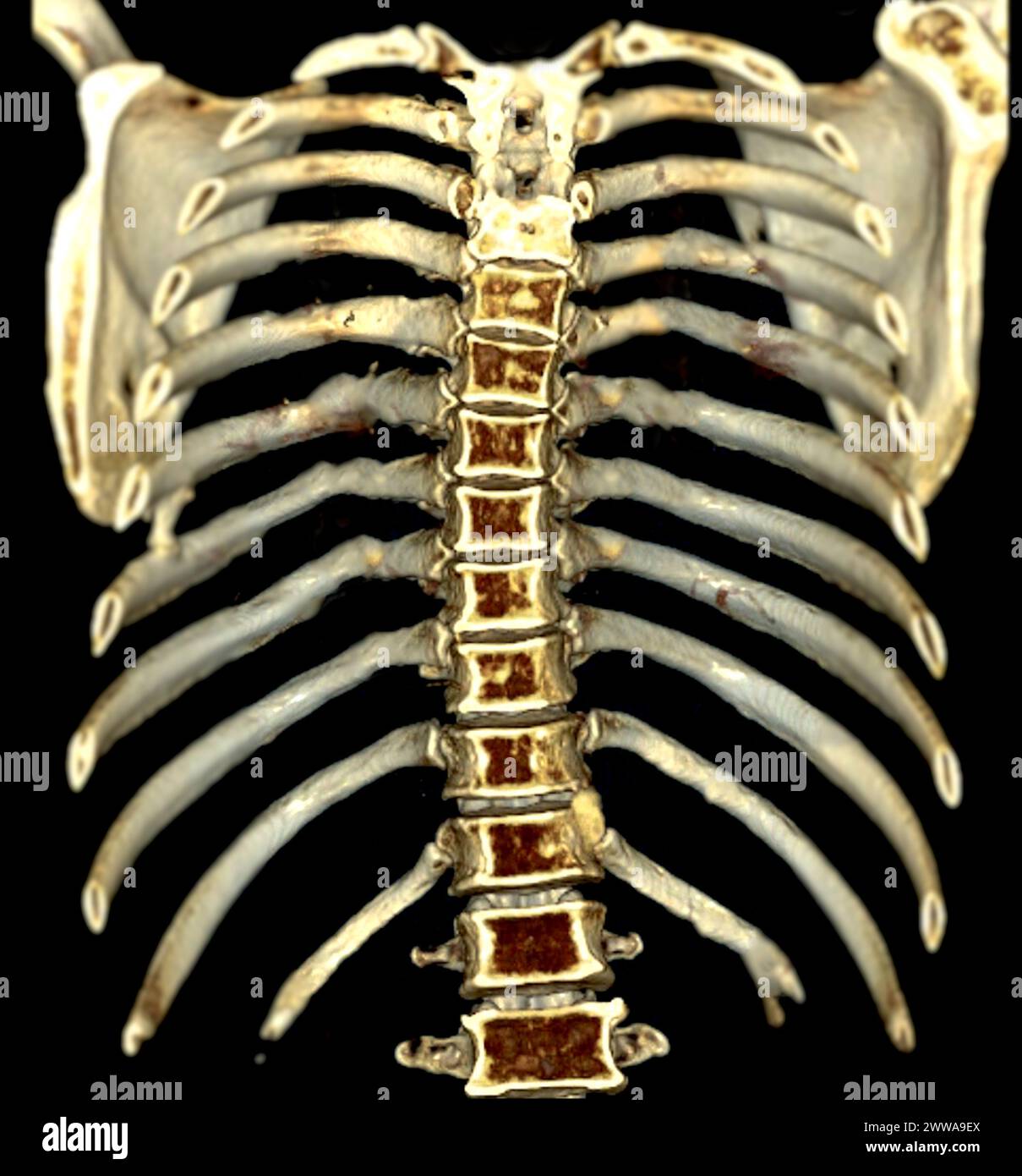 Le rendu 3D des côtes par tomodensitométrie fournit une imagerie précise des structures des côtes. Banque D'Images