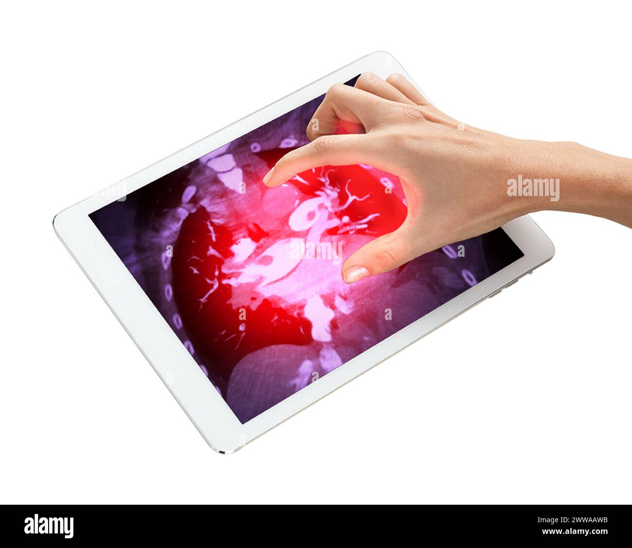 La main dans l'image guide votre attention sur la tablette, où une représentation visuelle représente l'embolie pulmonaire, facilitant ainsi la compréhension.Clip Banque D'Images