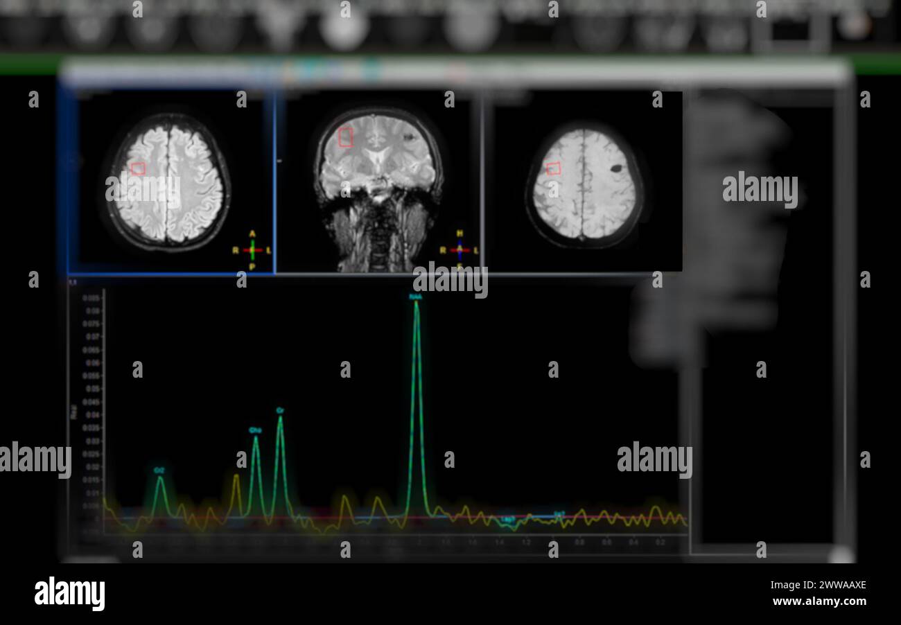 La SPECTROSCOPIE RM aide à traiter les maladies cérébrales, fournissant une analyse chimique approfondie pour comprendre les changements métaboliques dans les tissus cérébraux affectés. Banque D'Images