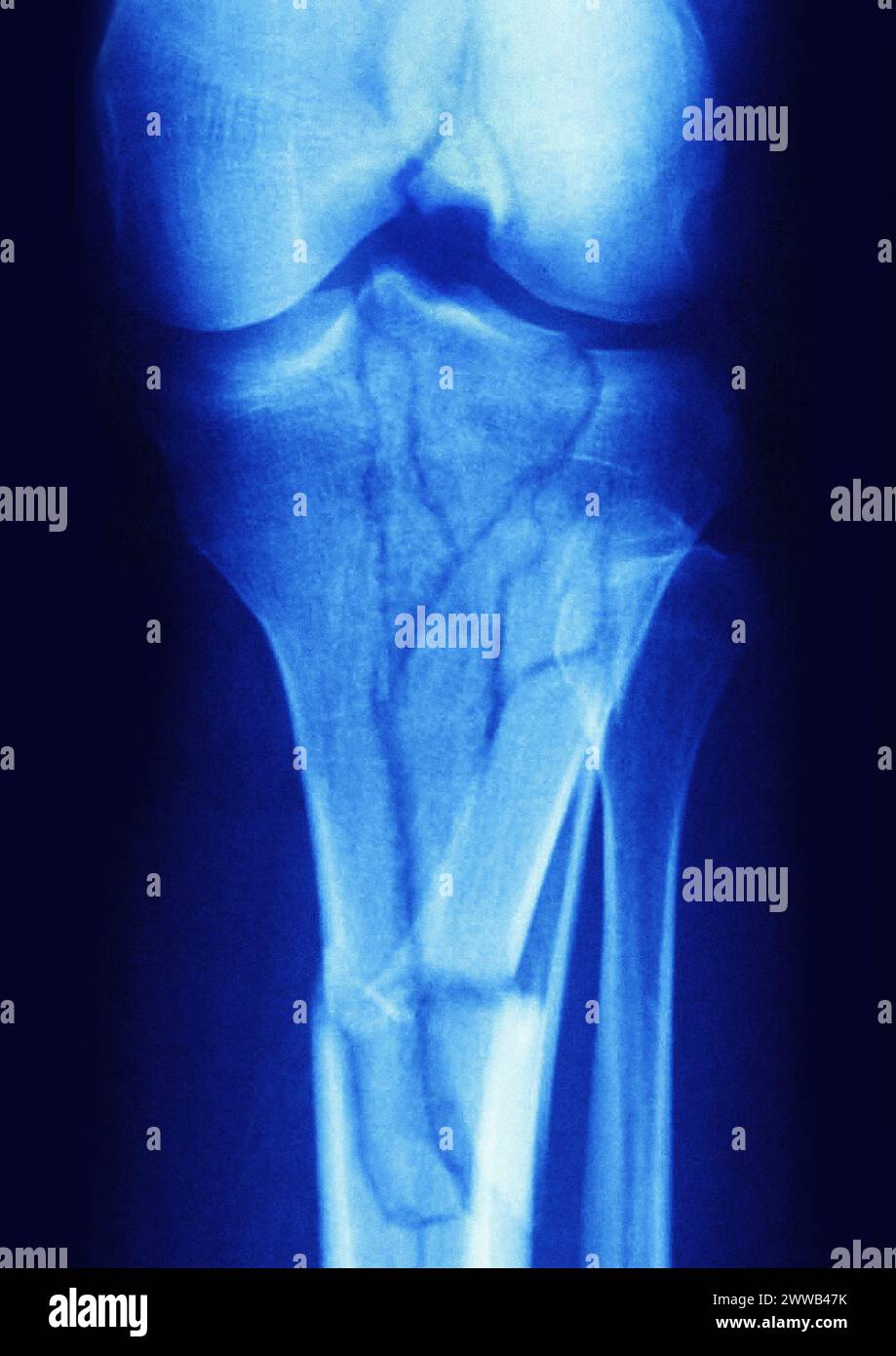 Tibial plateau Banque de photographies et d’images à haute résolution ...