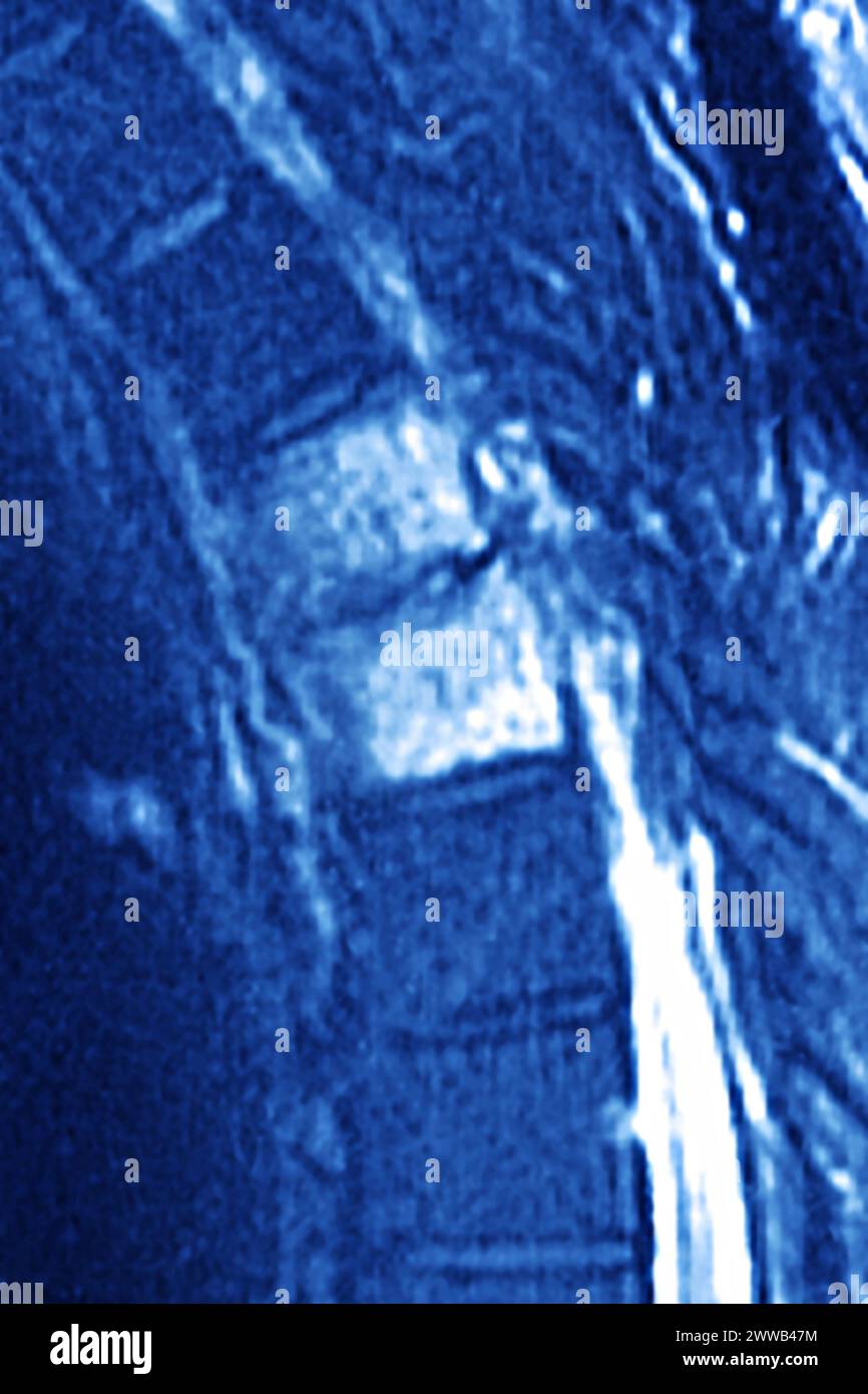 Ostéite vertébrale (inflammation du tissu osseux de deux vertèbres dorsales, causée par une infection bactérienne). Banque D'Images