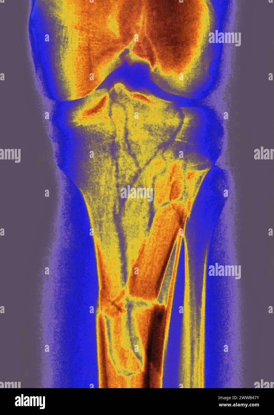 Fissure Tibia Choc _ Fracture Du Tibia – VYJSBI