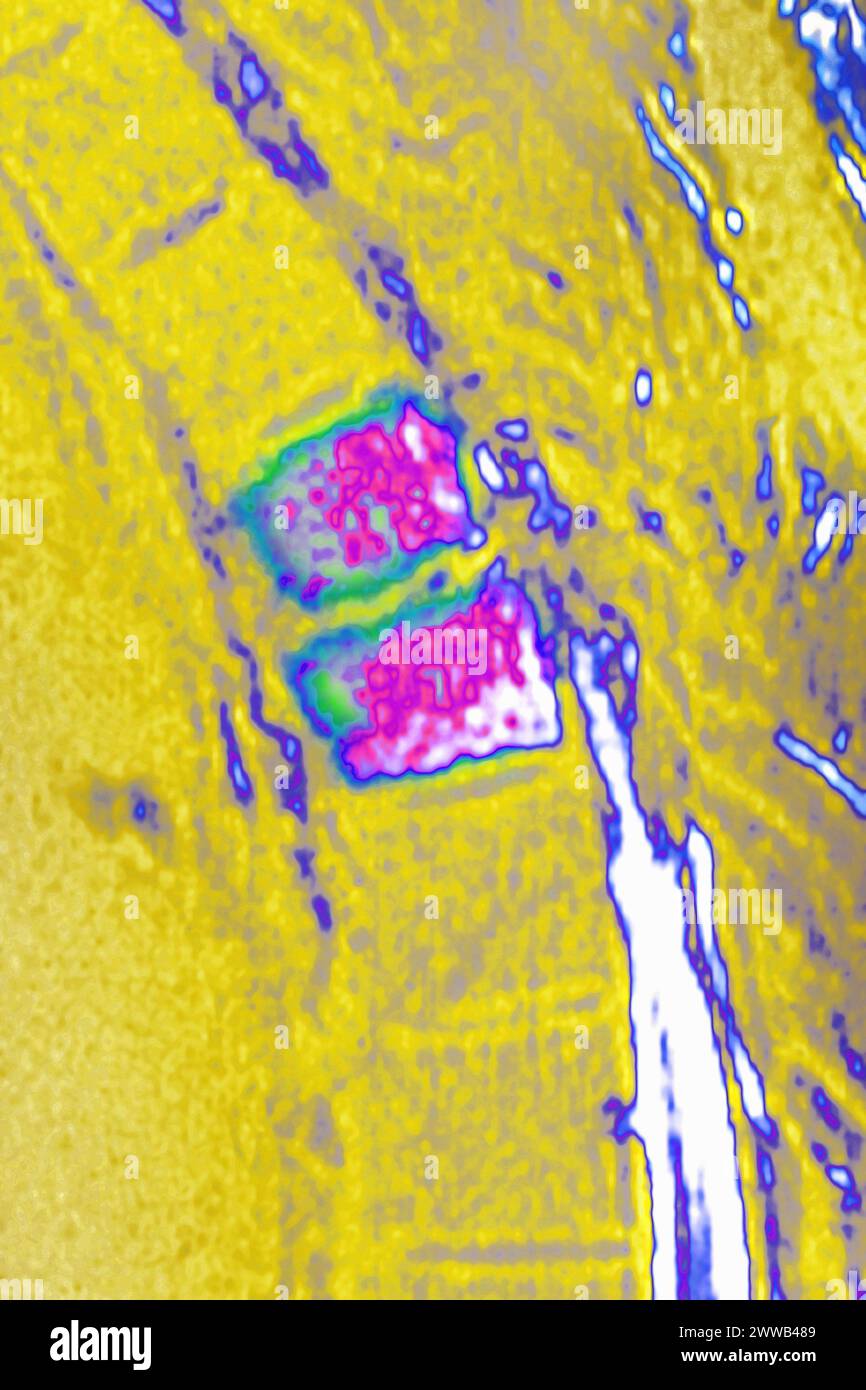 Ostéite vertébrale (inflammation du tissu osseux de deux vertèbres dorsales, causée par une infection bactérienne). Banque D'Images