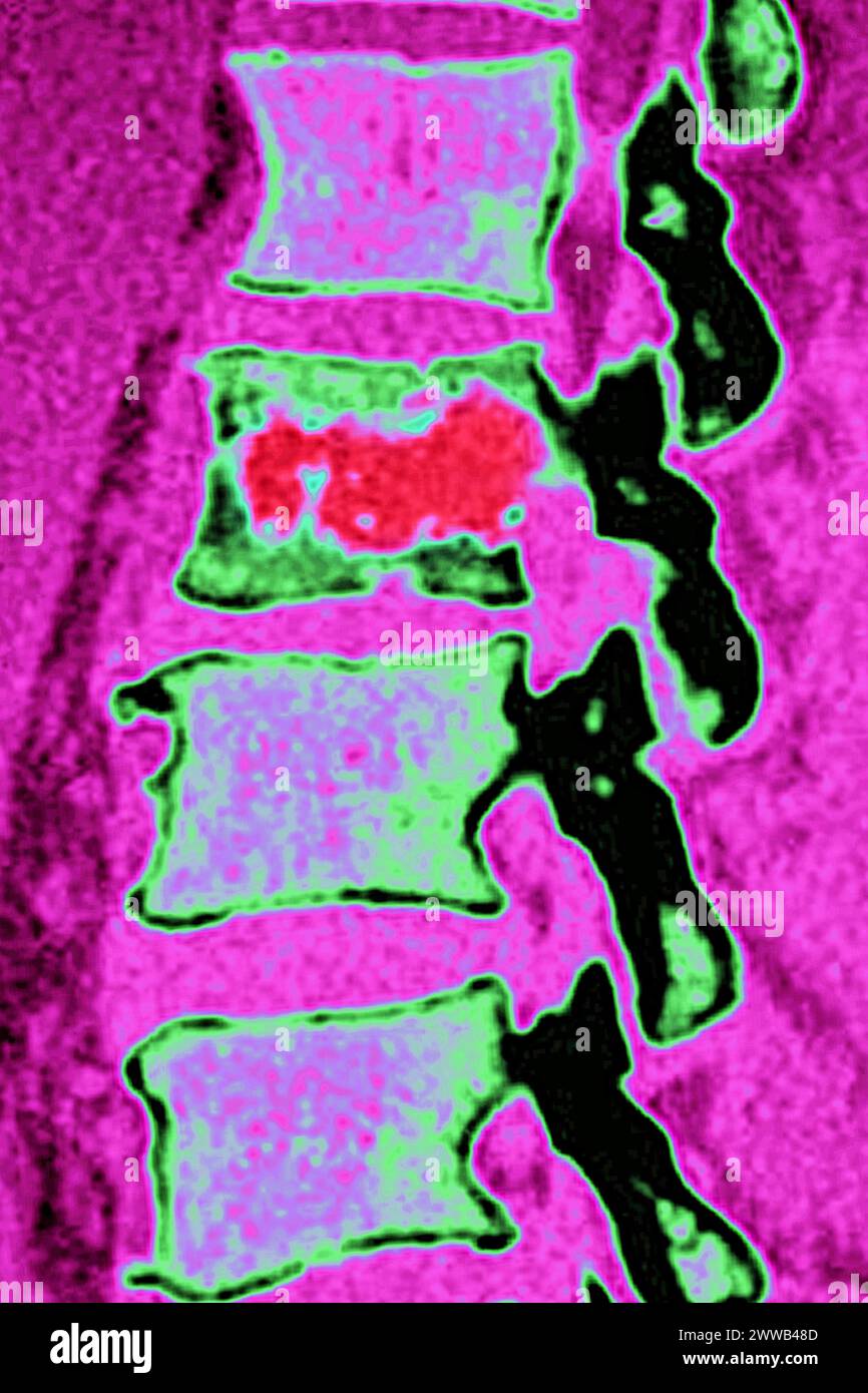 Ostéite vertébrale (inflammation du tissu osseux d'une vertèbre ...