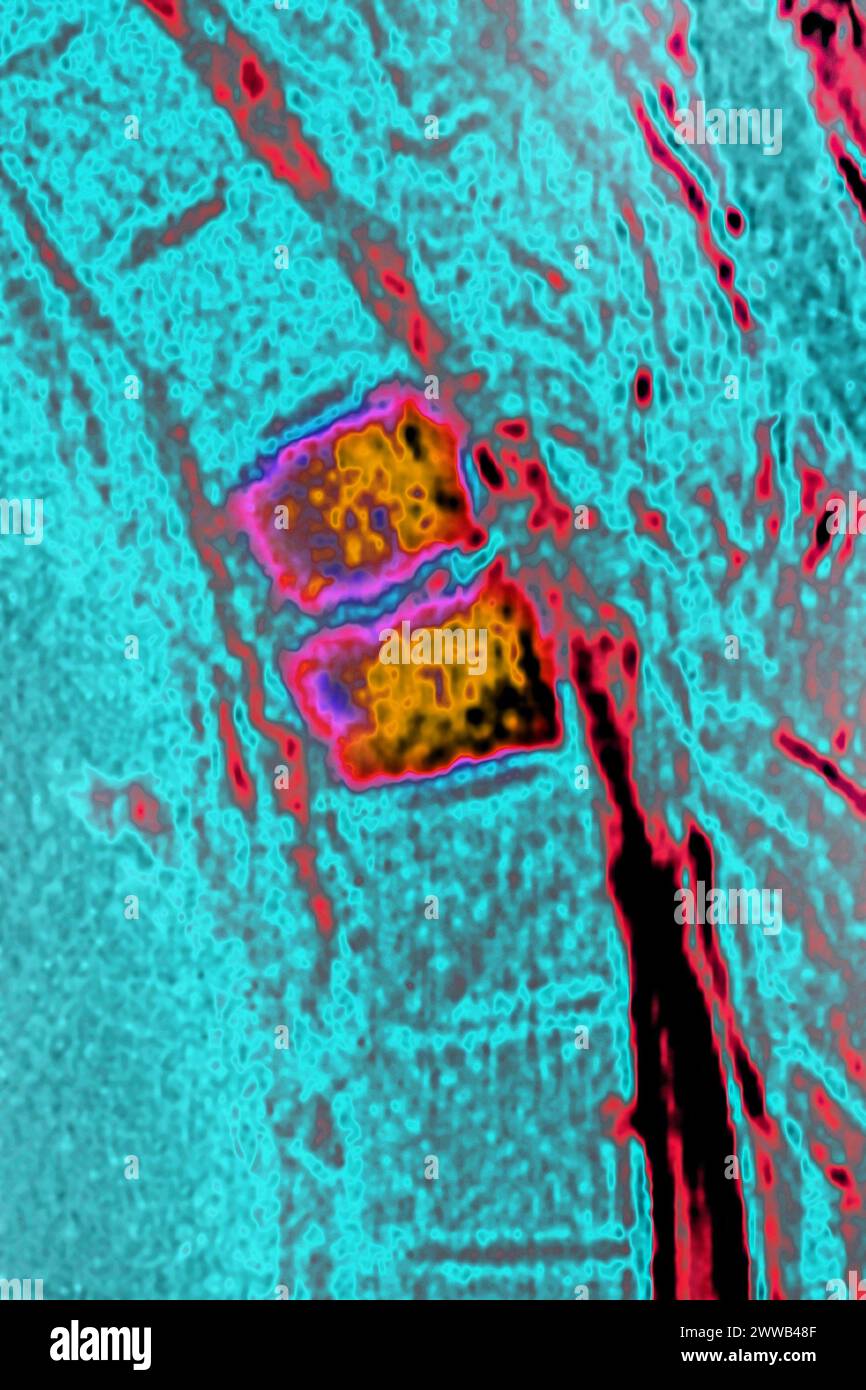 Ostéite vertébrale (inflammation du tissu osseux de deux vertèbres dorsales, causée par une infection bactérienne). Banque D'Images