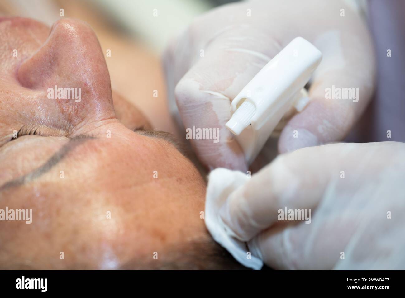 Peeling du visage. Au cabinet d'un dermatologue parisien. Banque D'Images