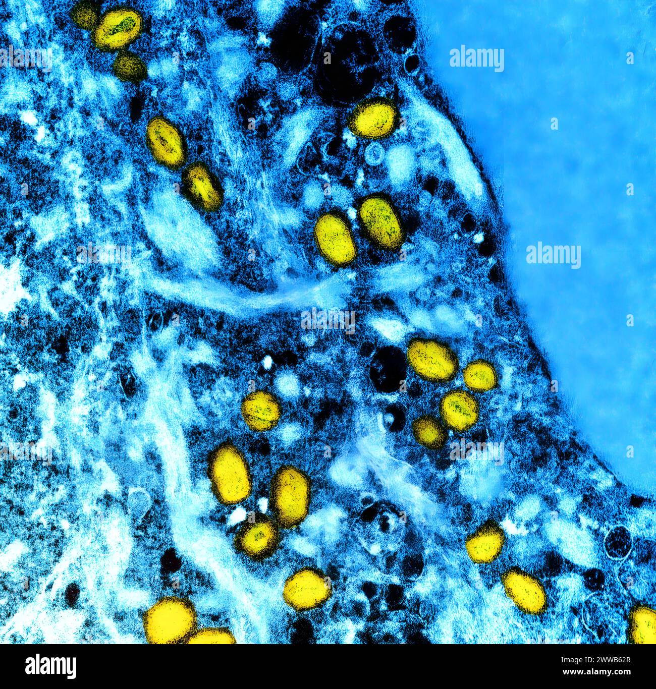 Micrographie électronique à transmission colorisée des particules de variole du singe (jaune) trouvées dans une cellule infectée (bleue), cultivées en laboratoire. Banque D'Images