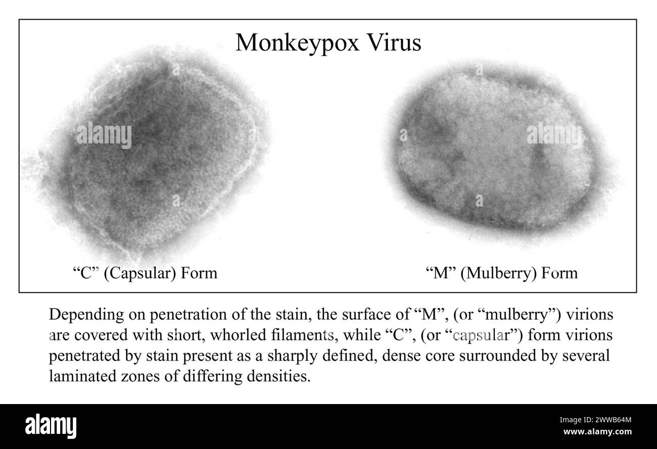 Composite de deux images de micrographie électronique à transmission négative (TEM) de taches fortement agrandies de deux formes de virus de la variole du singe. Banque D'Images