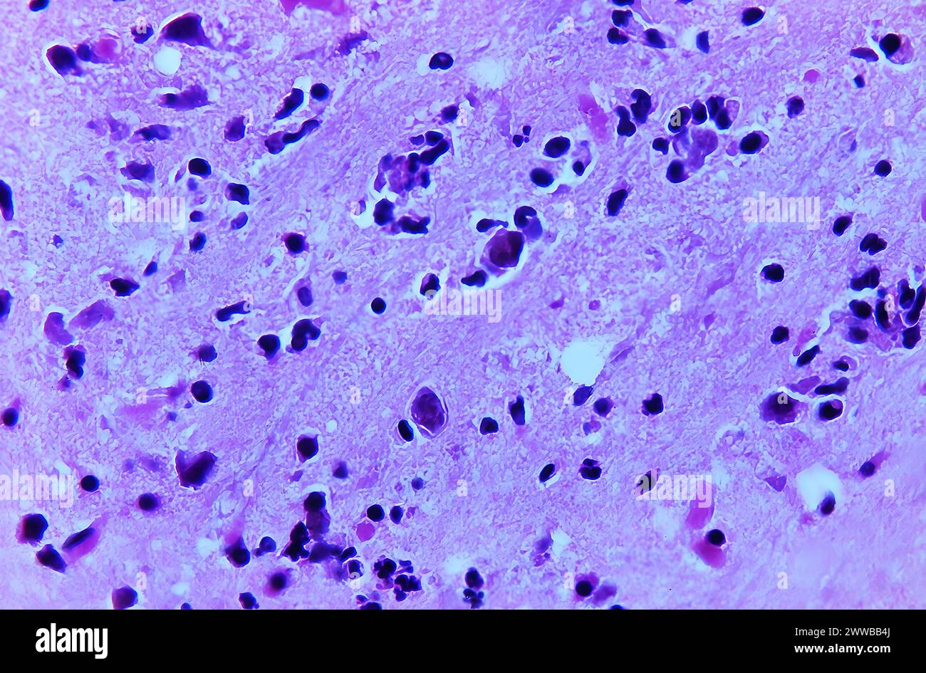Cette photomicrographie d'un échantillon de tissu cérébral de souris a révélé la présence d'une partie de l'histopathologie causée par un Acanthamoeba polyphaga amibien. Banque D'Images