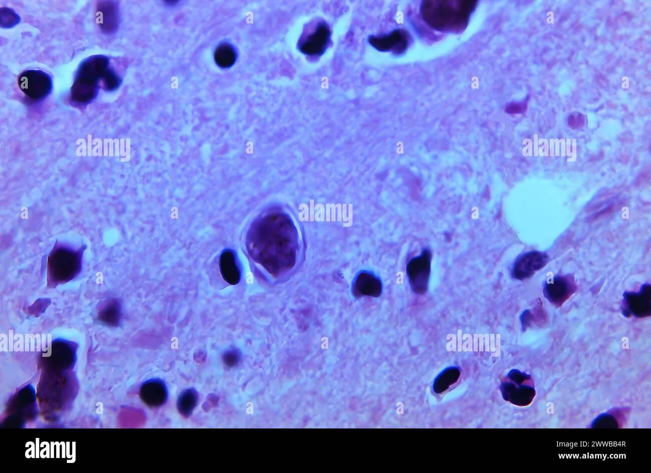 Cette photomicrographie d'un échantillon de tissu cérébral de souris a révélé la présence d'une partie de l'histopathologie causée par un Acanthamoeba polyphaga amibien. Banque D'Images