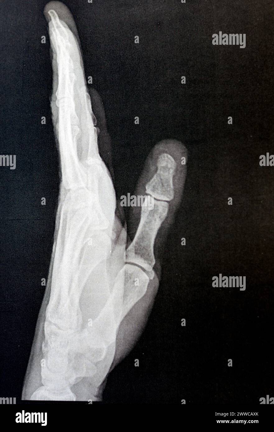 Radiographie simple de la main gauche d'un homme adulte après un traumatisme direct au doigt du pouce gauche montrant une étude osseuse normale, radiographie normale de la main à ex Banque D'Images