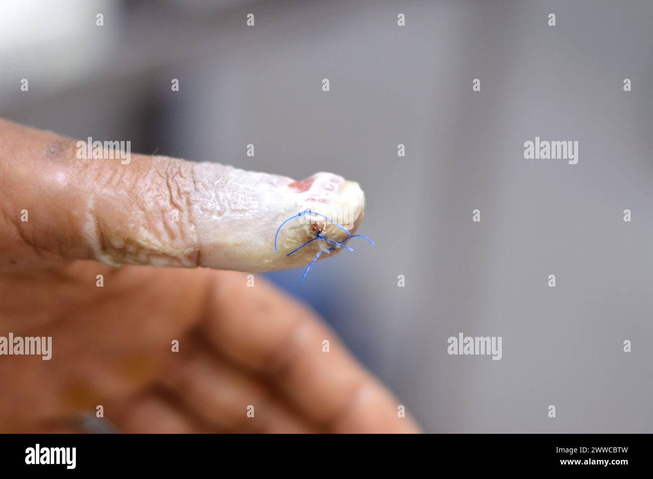 un pouce de la main gauche avec ablation chirurgicale de l'ongle du pouce, et des points de suture d'une plaie coupée après un traumatisme direct au doigt qui a causé des dommages o Banque D'Images