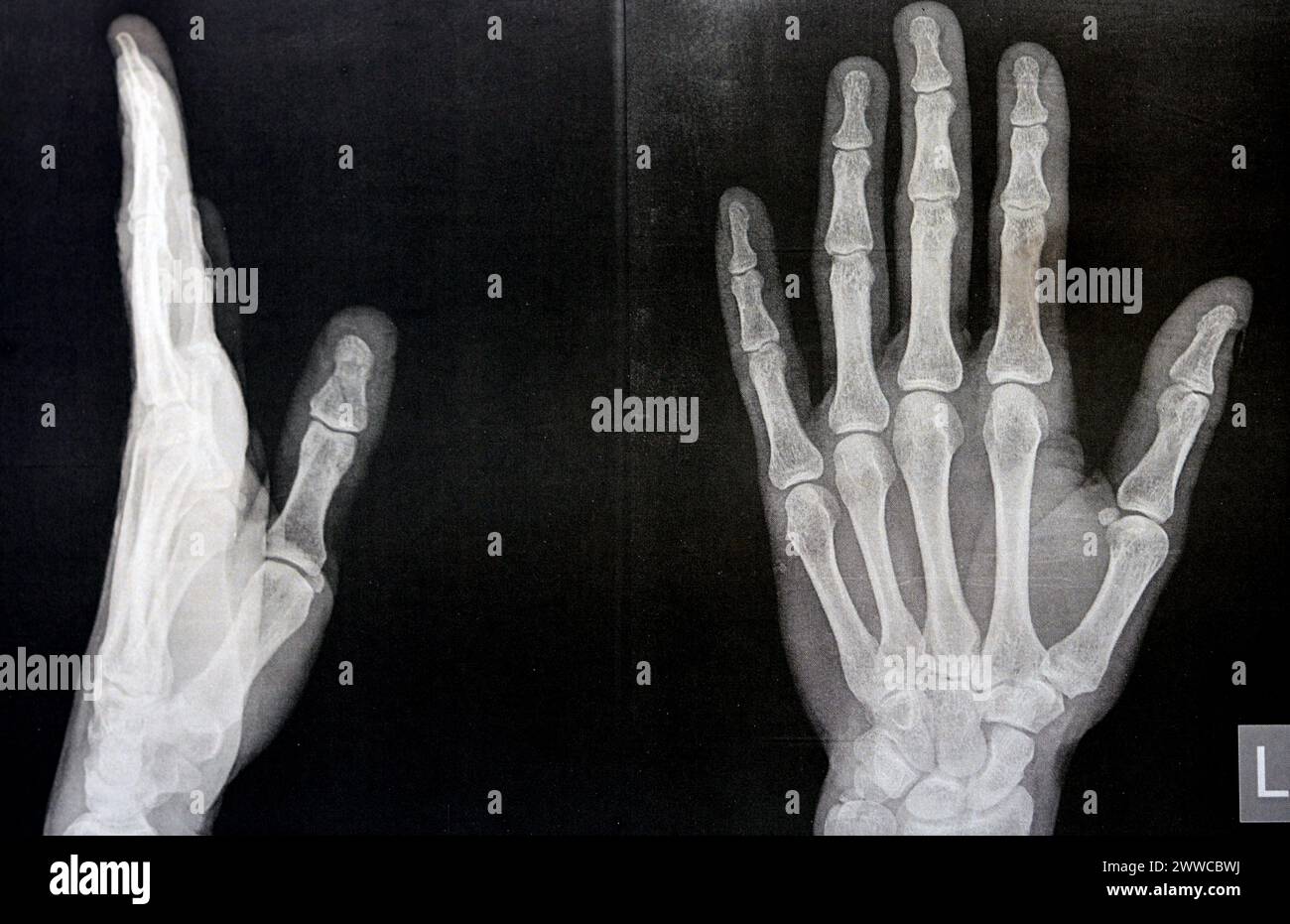 Radiographie simple de la main gauche d'un homme adulte après un traumatisme direct au doigt du pouce gauche montrant une étude osseuse normale, radiographie normale de la main à ex Banque D'Images