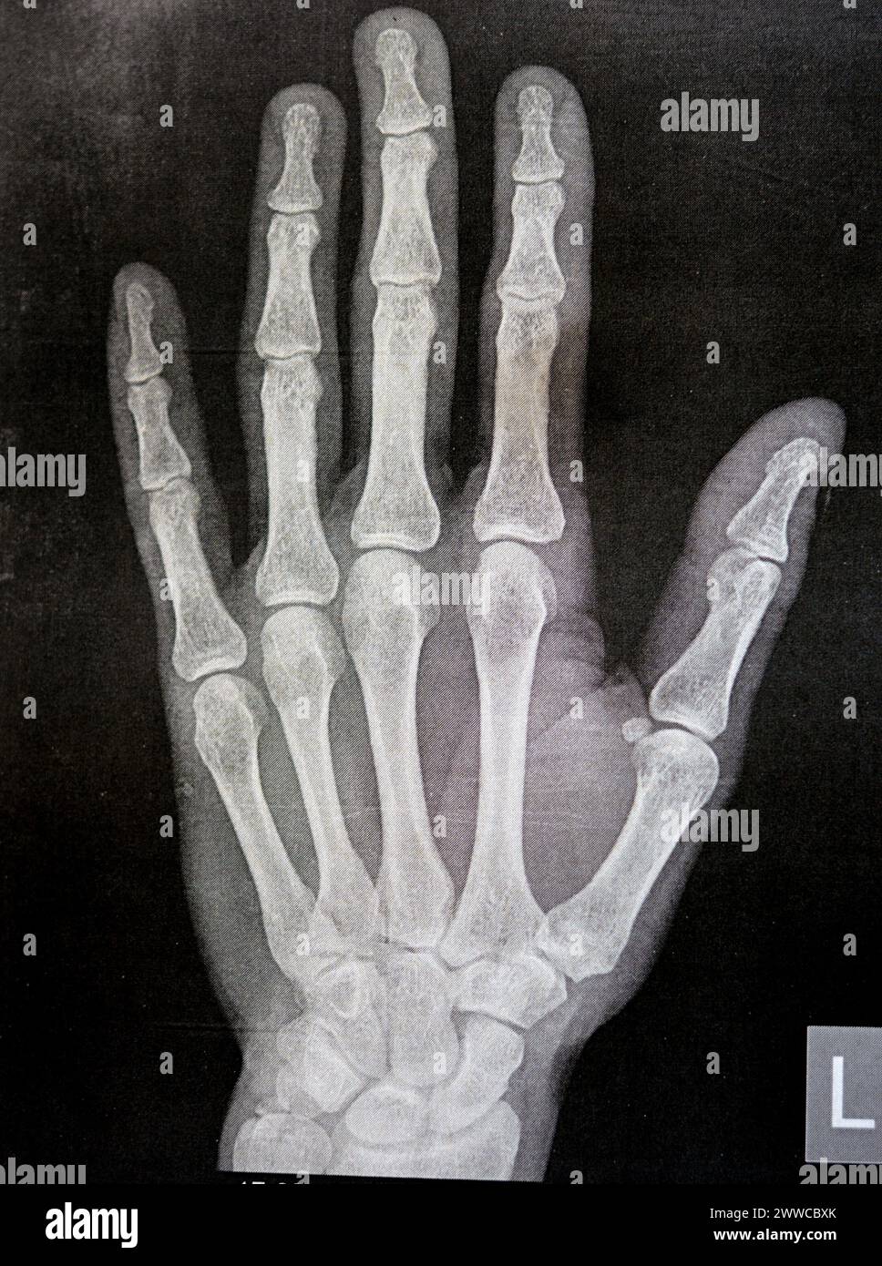 Radiographie simple de la main gauche d'un homme adulte après un traumatisme direct au doigt du pouce gauche montrant une étude osseuse normale, radiographie normale de la main à ex Banque D'Images
