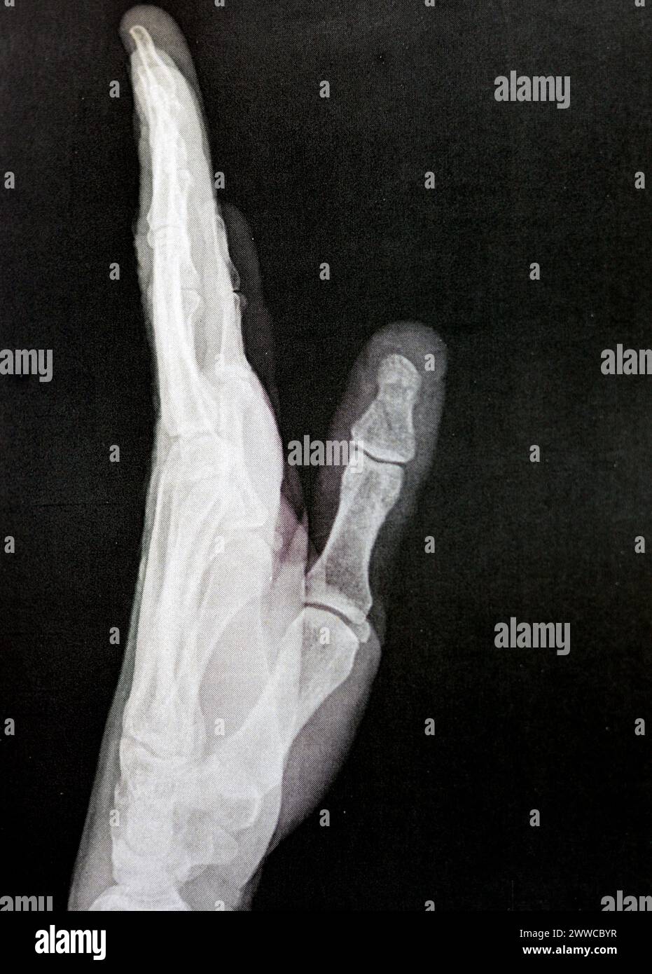 Radiographie simple de la main gauche d'un homme adulte après un traumatisme direct au doigt du pouce gauche montrant une étude osseuse normale, radiographie normale de la main à ex Banque D'Images