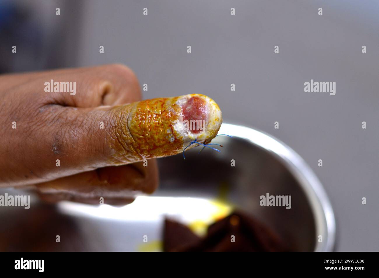 un pouce de la main gauche avec ablation chirurgicale de l'ongle du pouce, et des points de suture d'une plaie coupée après un traumatisme direct au doigt qui a causé des dommages o Banque D'Images