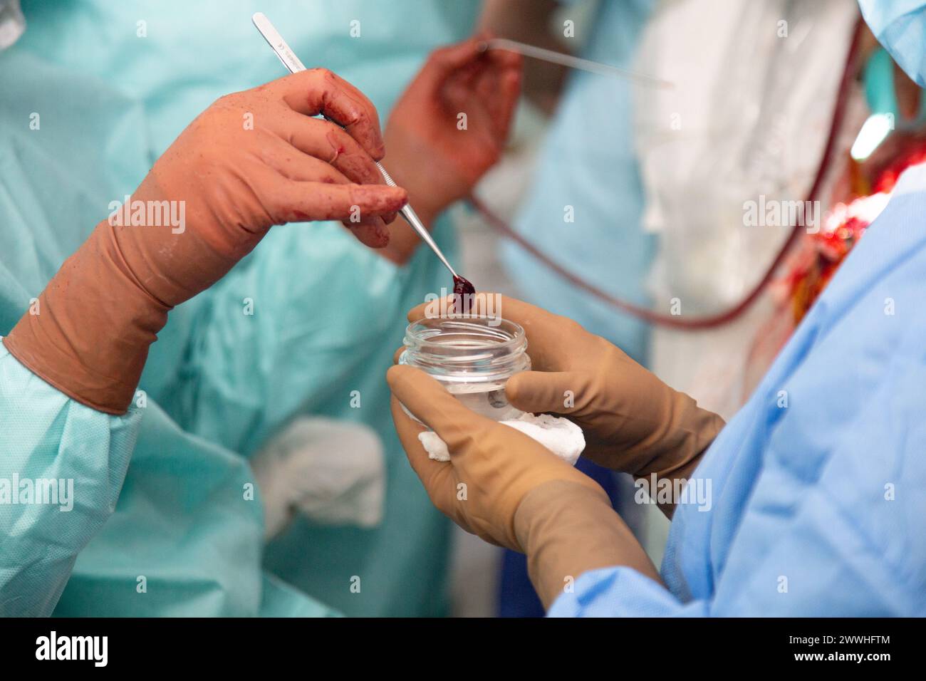 Le médecin montre la tumeur cancéreuse qu'il a enlevée pendant l'opération. Chirurgie de retrait de l'oncologie. Véritable salle d'opération. Photo de haute qualité Banque D'Images