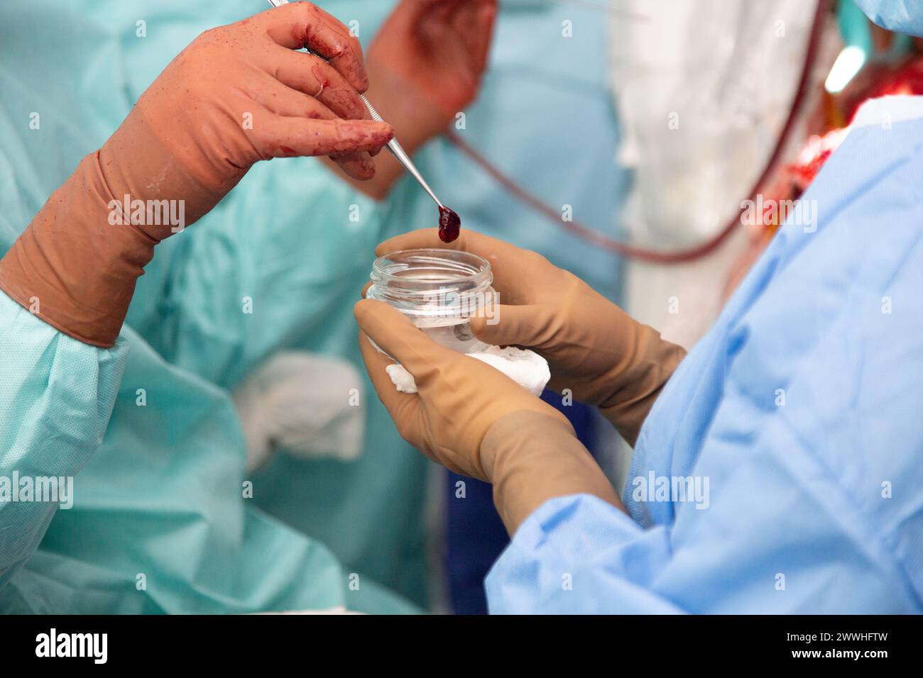 Le médecin montre la tumeur cancéreuse qu'il a enlevée pendant l'opération. Chirurgie de retrait de l'oncologie. Véritable salle d'opération. Photo de haute qualité Banque D'Images