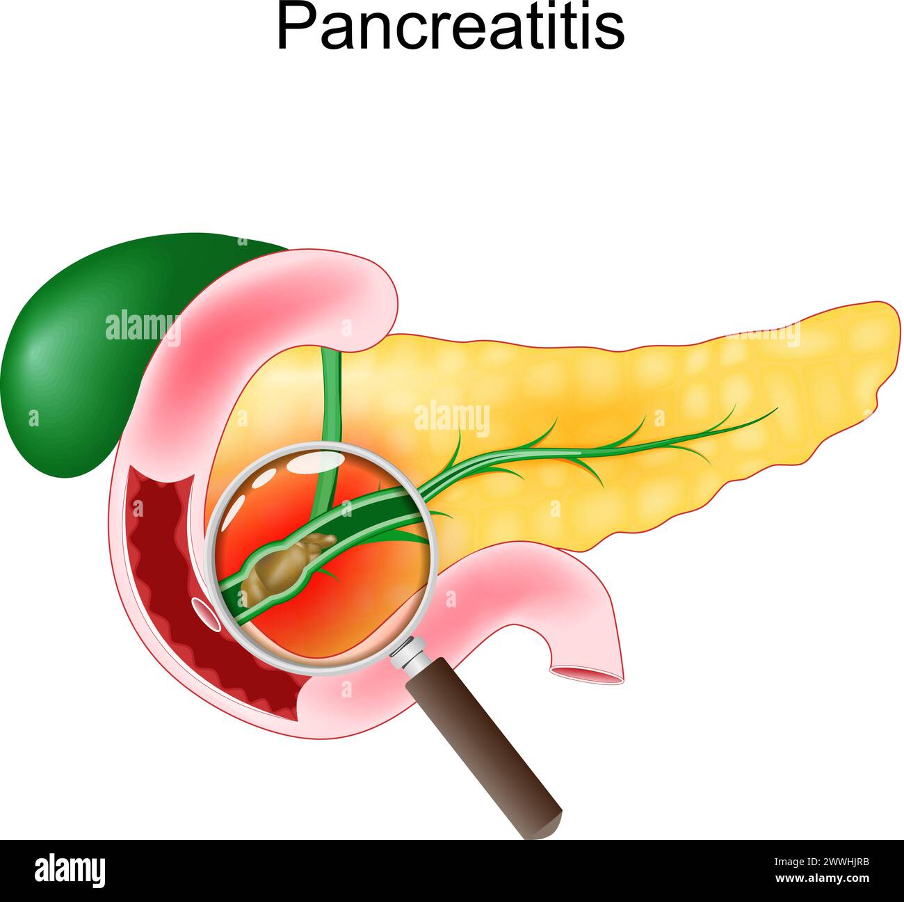 Pancréatites aiguës. Gros plan d'un pancréas, duodénum et vésicule biliaire réalistes. Coupe transversale d'un canal pancréatique avec des calculs biliaires vue à travers un mag Illustration de Vecteur
