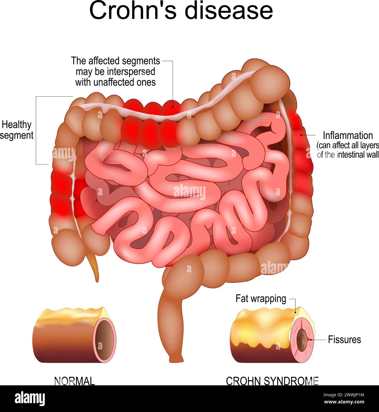 Maladie de Crohn. Intestin grêle et gros intestin humain avec des segments sains et une inflammation qui affectent les couches de la paroi intestinale. Segment affecté Illustration de Vecteur