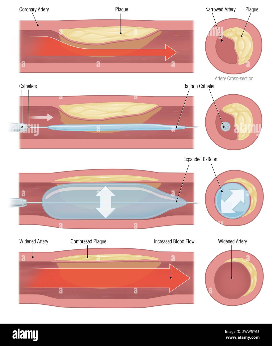 implantation de stent pour favoriser la circulation sanguine dans les vaisseaux sanguins Banque D'Images