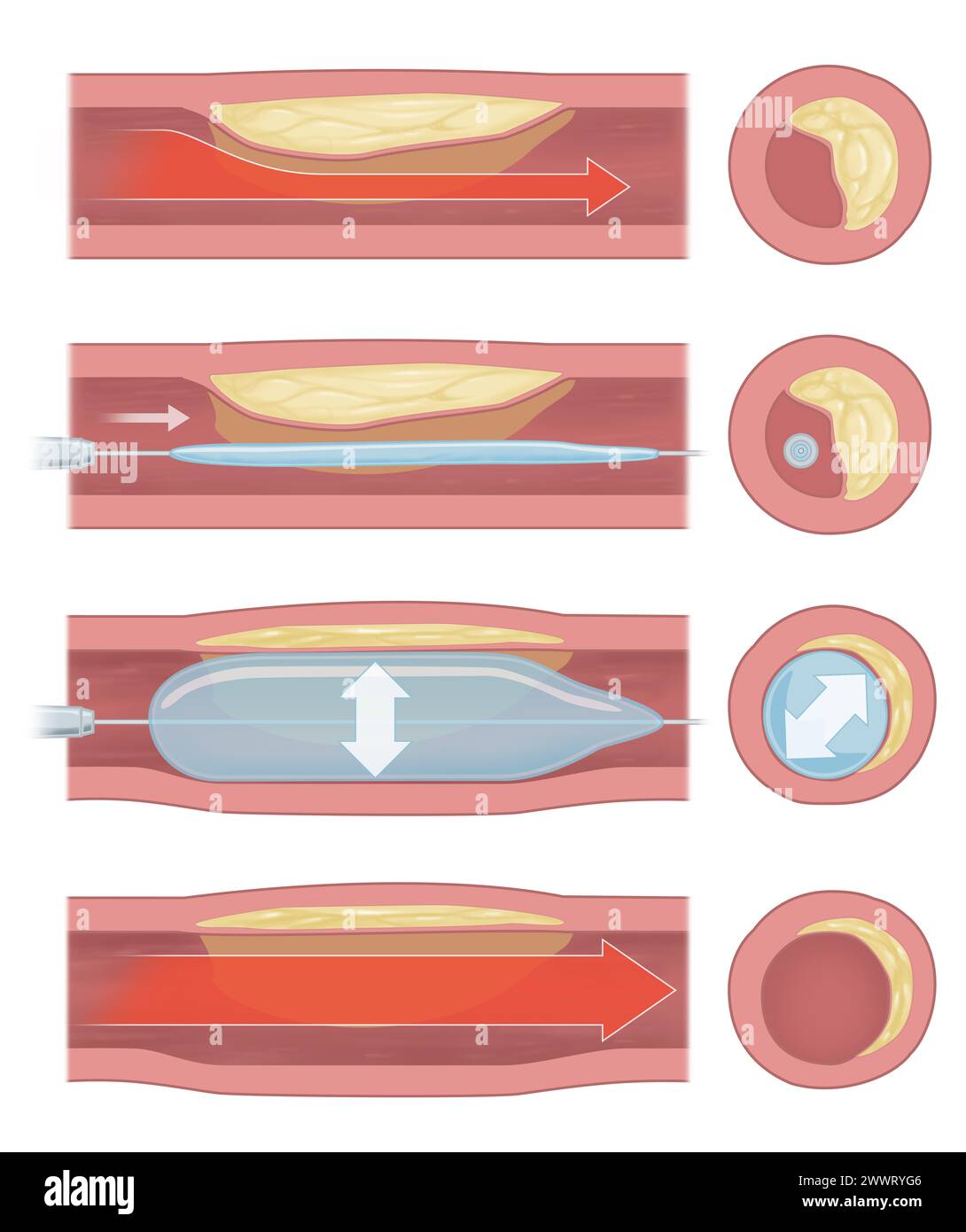 implantation de stent pour favoriser la circulation sanguine dans les vaisseaux sanguins Banque D'Images