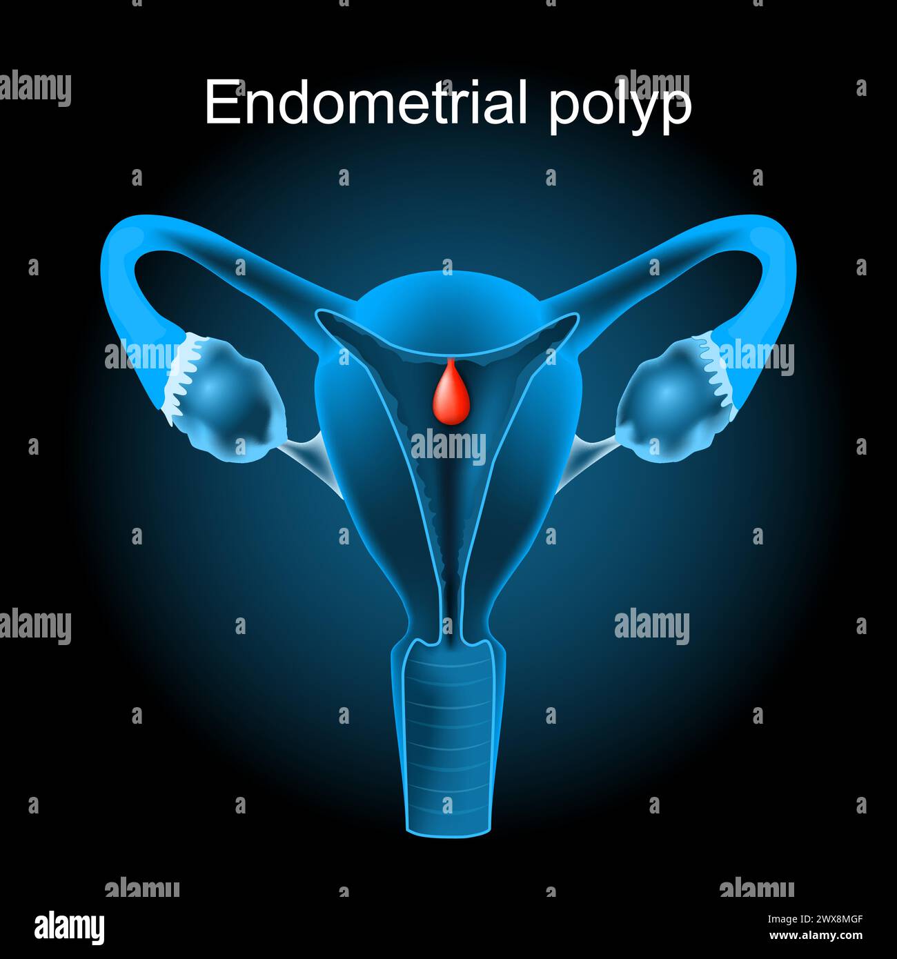 Polype endométrial. Section transversale d'un utérus humain avec polype utérin. appareil reproducteur féminin. Illustration vectorielle comme une image radiographique. Reproduction Illustration de Vecteur