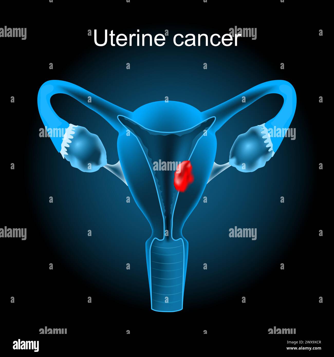 Cancer utérin. Section transversale d'un utérus humain avec tumeur endométriale. appareil reproducteur féminin. Illustration vectorielle comme une image radiographique. Reproduction Illustration de Vecteur