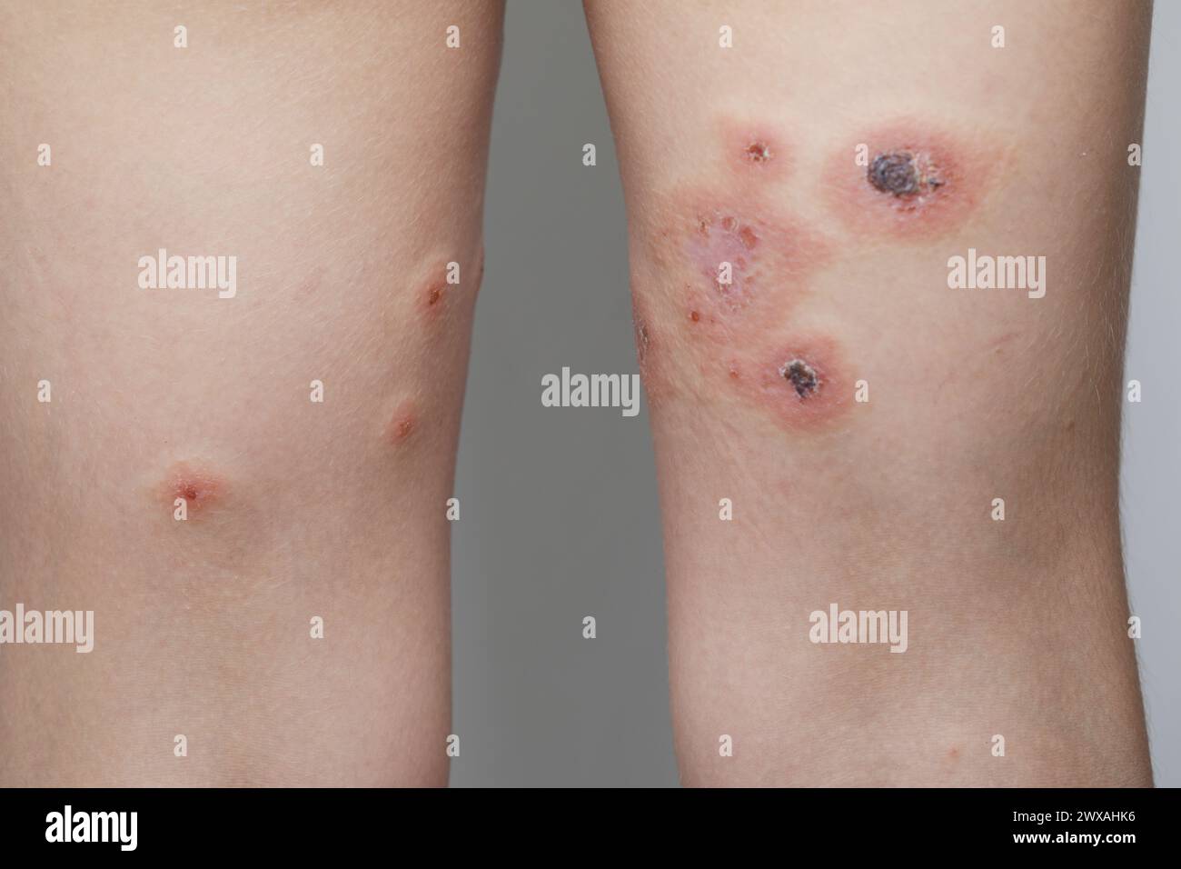 Les jambes humaines se rapprochent. Allergie, dermatite, infection virale ou bactérienne. Maladie infectieuse. Dermatologie, médecine et concept de soins. Banque D'Images