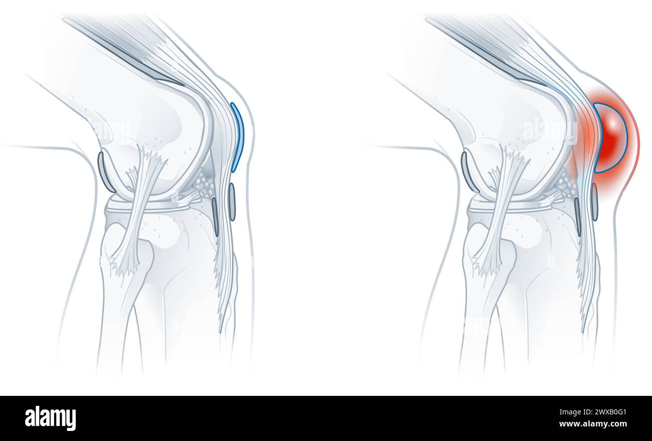 Bursite prépatellaire, inflammation de la bourse séreuse devant la rotule, provoque un gonflement, de la douleur et une sensibilité. Généralement dû à un traumatisme ou à un k répétitif Banque D'Images