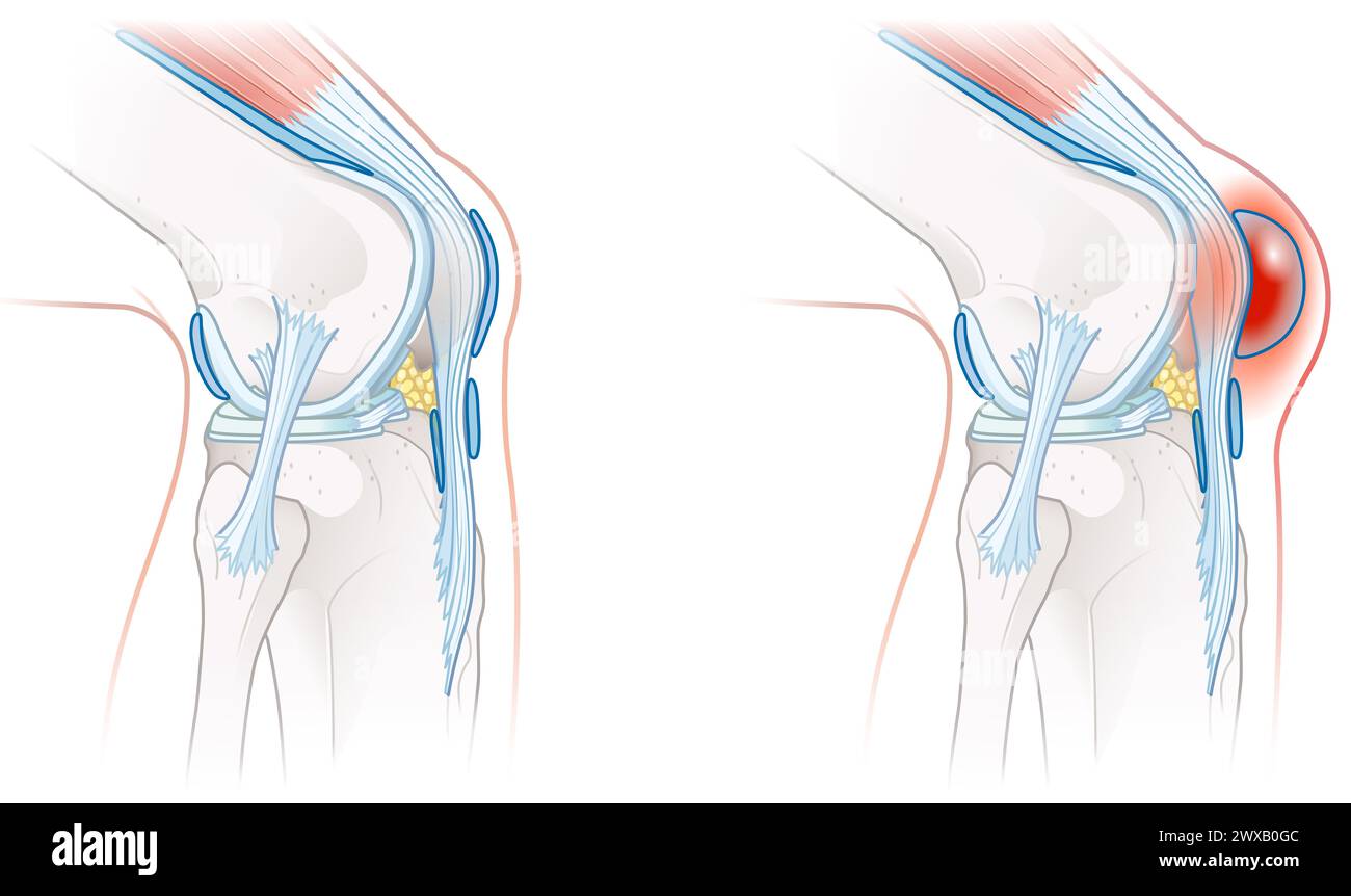 Bursite prépatellaire, inflammation de la bourse séreuse devant la rotule, provoque un gonflement, de la douleur et une sensibilité. Généralement dû à un traumatisme ou à un k répétitif Banque D'Images