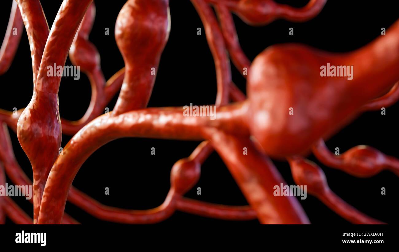 3d rendu des micro-anévrismes (MAS), ce sont de petits gonflements des vaisseaux sanguins dans la rétine Banque D'Images